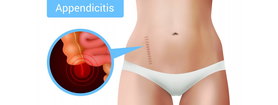 Appendicitis symptoms causes and homeopathic medicine
