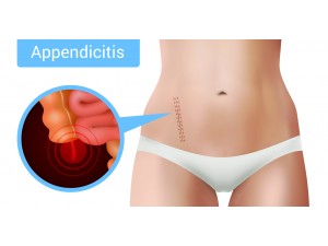 Appendicitis symptoms causes and homeopathic medicine