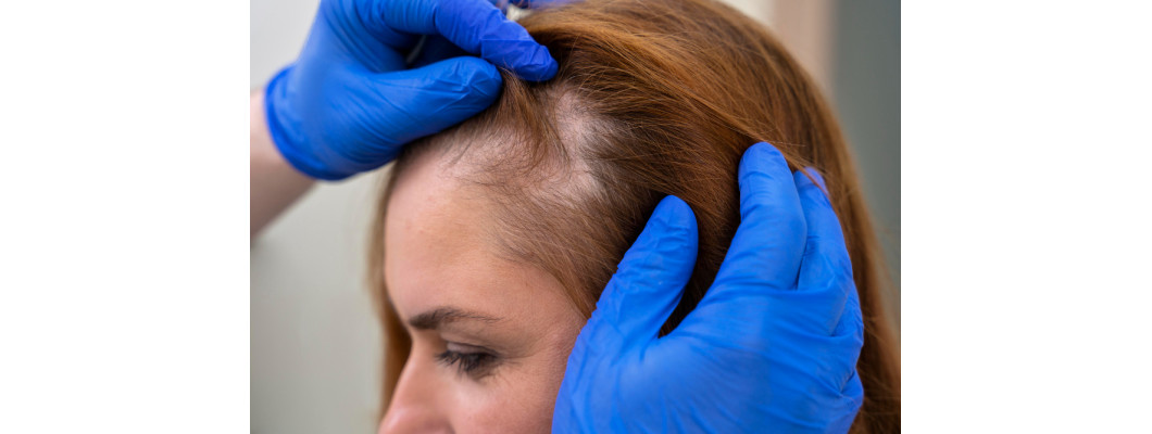 10 Best Home Remedies for Hair Fall 10 Best Home Remedies for Hair Fall