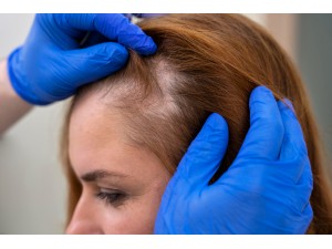 10 Best Home Remedies for Hair Fall