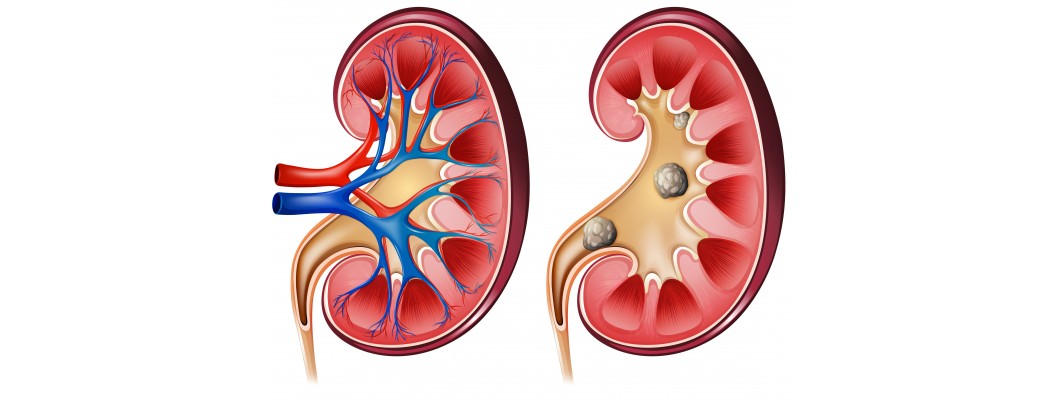 5 best Homeopathic medicines for Kidney Stones