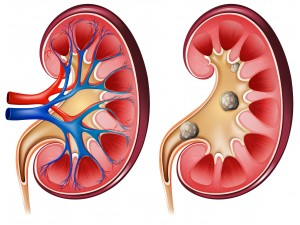 5 best Homeopathic medicines for Kidney Stones